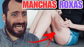 MANCHAS ROXAS NO CORPO, Machas roxas na perna, qual a causa, tratamento e 83% das pessoas nao sabem