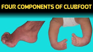 four components of clubfoot