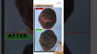 Amazing QR678 Treatment Results! Hair Fall Before & After #shorts  #shortvideo #stophairloss