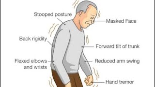 #Parkinson’s  Disease Features In Short Video 🧠