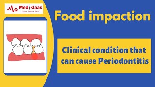 Food impaction - A cause for periodontitis | Caries | gum problem |Mediklaas