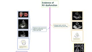 Diagnostic Algorithm for High risk Pulmonary Embolism