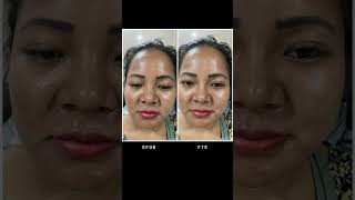 Nonsurgical rhinoplasty - Dr. Asma Dermatologist Lucknow