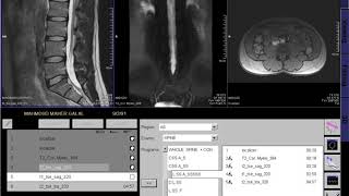 MRI l.Spine