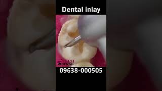 দাঁতের কালো দাগ দূর করতে Dental Inlay