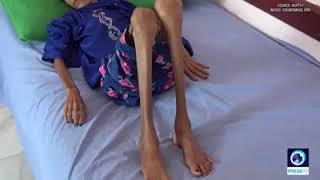 12-year-old Yemeni girl weighs 10kg due to severe malnutrition