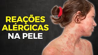 DERMATITE DE CONTATO - EVITE E TRATE REAÇÕES ALÉRGICAS NA PELE