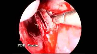 Septal spur removal