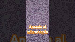 Así se ve la anemia al microscopio #hematología #anemia #laboratorioclinico