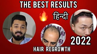 THE BEST RESULTS|2022|    Hair|Line|HairFall|TRANSPLANT|MINOXIDIL|FINASTERIDE|results|hindi