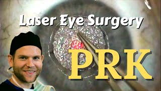 PRK laser eye surgery, the lasik alternative to awesome vision! (in entirety)