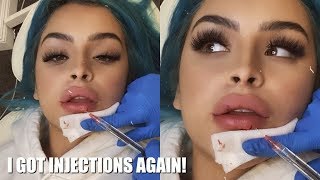 I got PAINLESS Lip Injections!