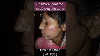 Chemical peel for Cystic Acne// Before and After Results @DrArifMDDermatologist  #acnetreatment #skin