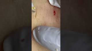 Big Cystic Acne Blackheads Extraction Blackheads & Milia, Whiteheads Removal Pimple Popping #shorts