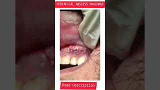 #shorts #youtubeshorts Periapical Abscess Drainage