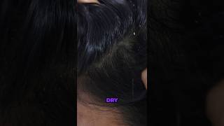 Get rid of dandruff overnight with this DIY #shorts #short #dandruff #haircare #diy #coconutoil