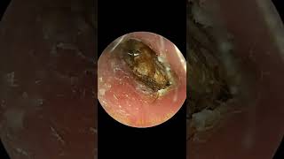 Deafening Yellow Earwax Scraped out