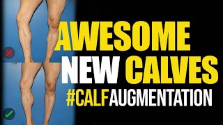 Calf Implants for Men in NYC and LA with Dr. Steinbrech