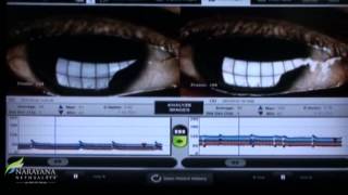 Lipiview Normal & Abnormal.mpg