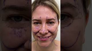 Ponytail Facelift: Day of Surgery Part 2 At Kao Plastic Surgery #facelift #beforeandafter