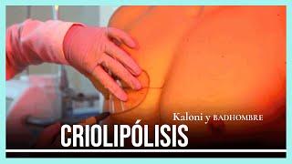 Criolipólisis (congelar la grasa) en Kaloni x BADHOMBRE