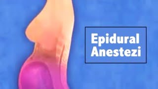 EPİDURAL ANESTEZİ UYGULAMASI