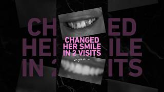 Changing smiles, changing lives #veneers #cosmetic #dentistry