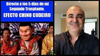 Cinco días del Segundo trasplante capilar [Efecto Chino Cudeiro]