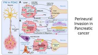 Perineural Invasion in pancreatic ductal adenocarcinoma (PDAC) #Code: 556