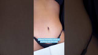 Tummy tuck ✨