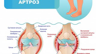 Если болят суставы, артроз, артрит,вот решение 👆‼️ для заказа  смотри в описании ссылку.⤵️⤵️⤵️