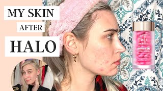 My Skin After Using Halo Beauty Vitamins | Did They Work?