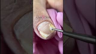 This nail could not be covered with gel polish #gelpolish #podologia #nailtreatment #nails #pedicure