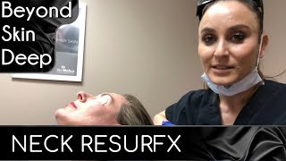 NECK RESURFX TREATMENT | For texture, lines and wrinkles (Basics & Overview)