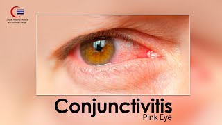 Conjunctivitis: Causes, Prevention, and Management