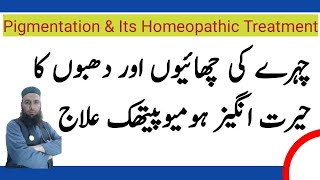 Homeopathic Treatment Of Face Freckles | Brown Spots On Nose | Pigmentation Treatment