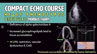 〖Echocardiography〗 Etiological phenotypes of HFpEF -  Fabry's disease 🫀