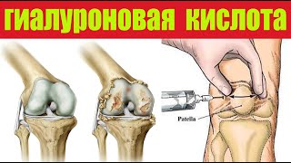 Гиалуроновая кислота- лекарство для лечения артроза, ревматизма, подагры