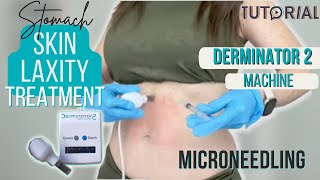 LOOSE STOMACH SKIN TIGHTENING GUIDE | Derminator 2 Microneedling