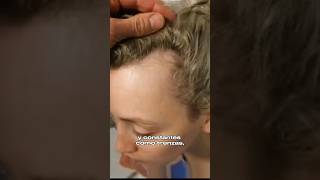 Alopecia por Tracción #shorts #youtubeshorts #hair #alopecia #youtube #health