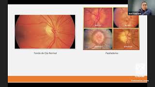 Modulo IV: Exploración neurológica nervio craneal óptico, por Dr. José Guerrero.