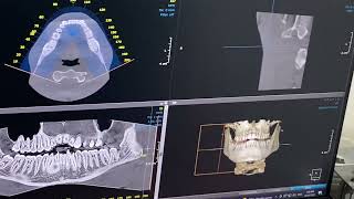 KAVO (DEXIS) OPG Pro CBCT wisdom teeth case Hawkesbury Dental