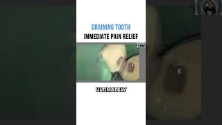 Draining Tooth? Immediate Pain Relief!