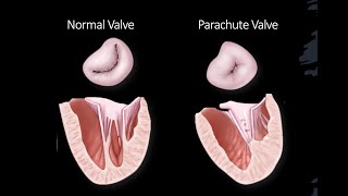 Arcade mitral valve, Parachute mitral valve and more