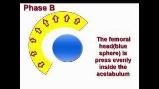 The basic concept of Hoffmann Daimler method in treatment of hip dysplasia