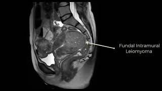 Fibroids Case 2.mp4