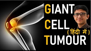 Giant Cell Tumour (GCT) Bone Hindi (ਪੰਜਾਬੀ subtitles) Symptoms, Causes, Treatment - Dr Rajat Gupta