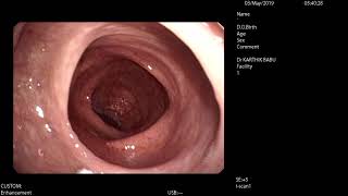 Amoebiasis of colon Reccurent Amoebic Colitis