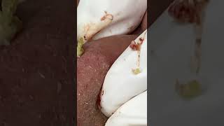 Big Cystic Acne Blackheads Extraction Blackheads & Milia, Whiteheads Removal Pimple Popping