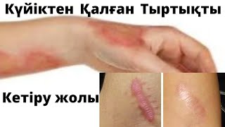 #күйіктен кейінгі тыртыкты кетіру